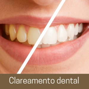 clareamentod dental2
